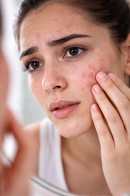 Sérum Anti-Acné Facial